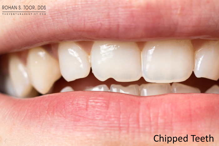 Invisible Braces and Chipped Teeth Repair Before & After Photos