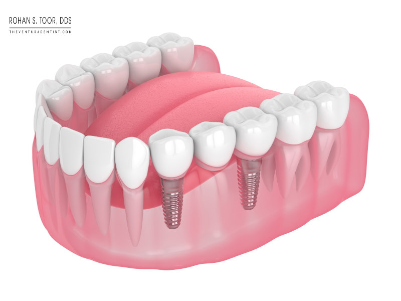 Partial Dentures: Process, Problems, Time it takes, Types