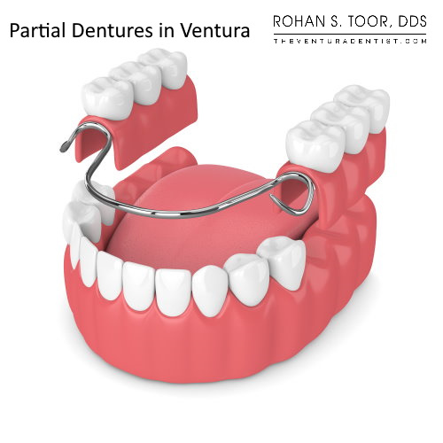 fixed partial denture all metal