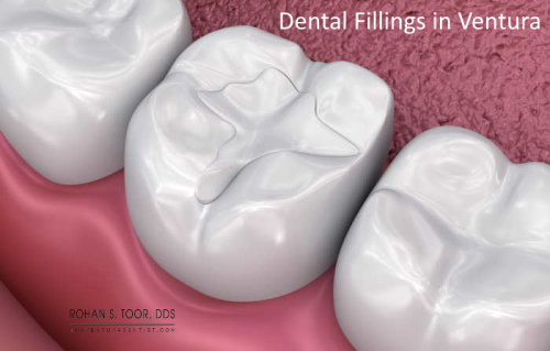 Fillings, Northwest Dental