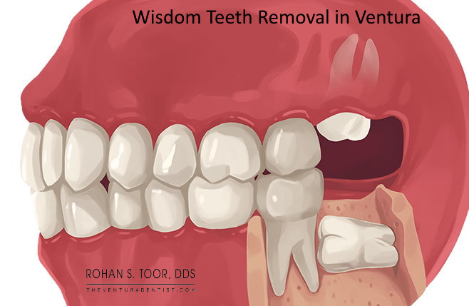 wisdom teeth removal swelling